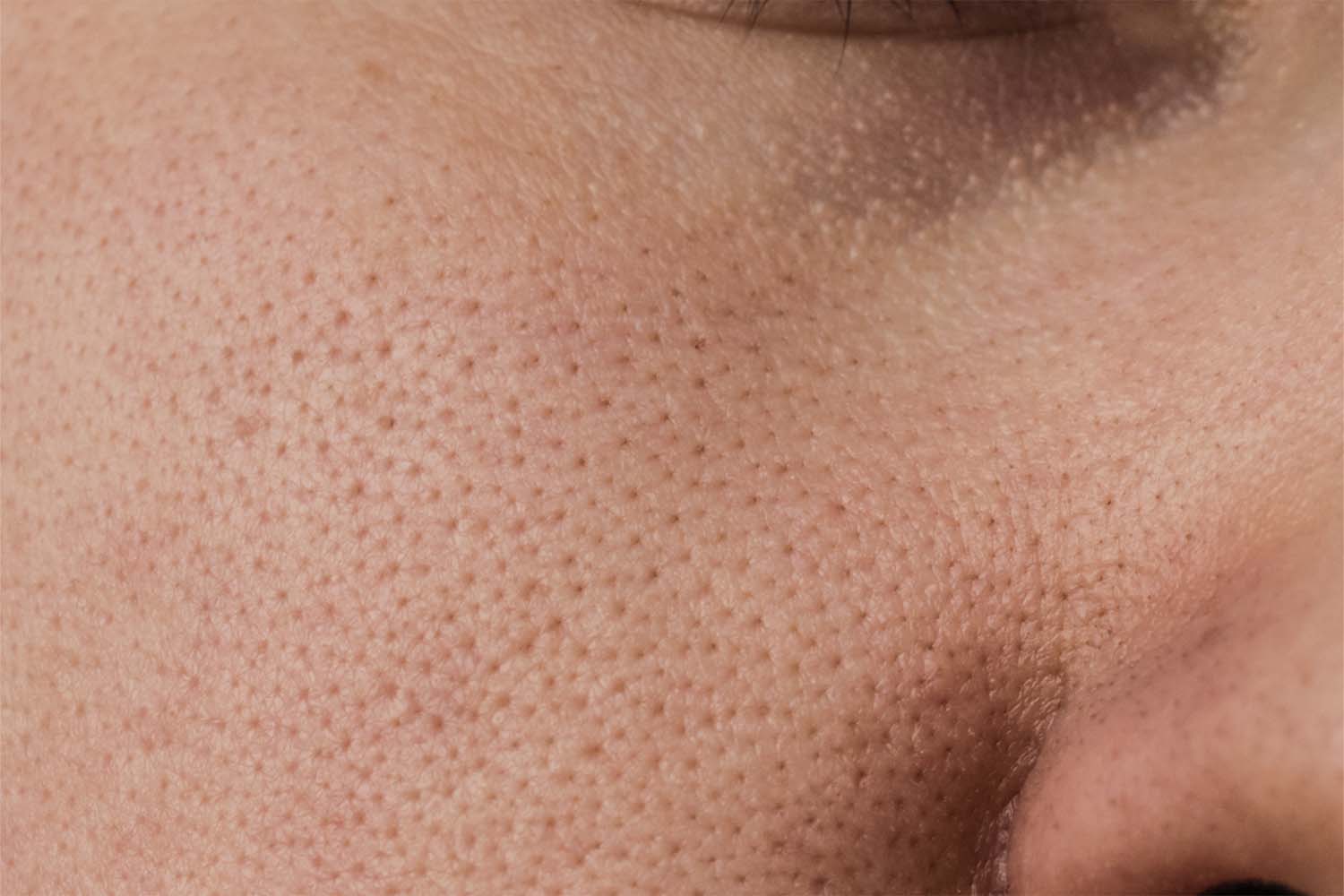 clogged pores before and after